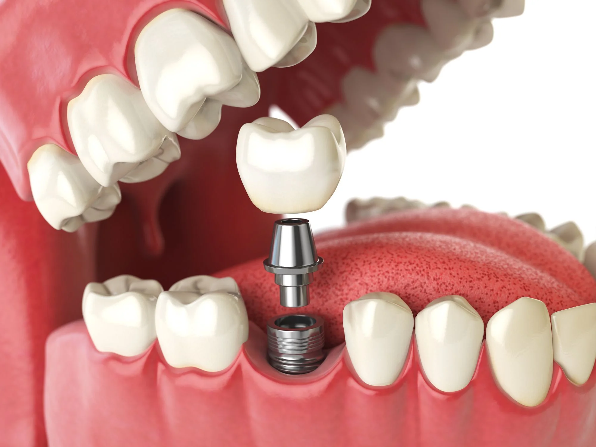 Elevating Oral Functionality with Next-Gen Oral Implants