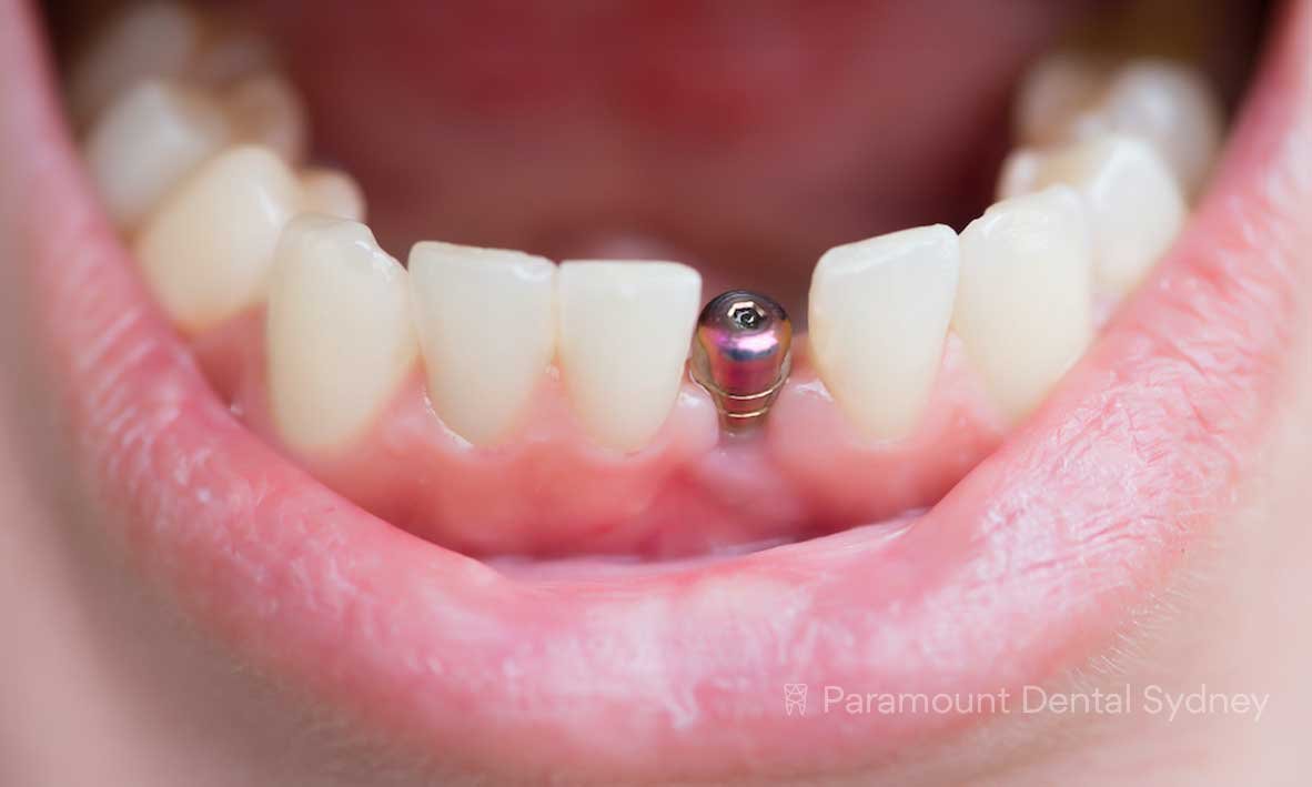 How Dental Implants Eliminate the Need for Messy Adhesives and Daily Removal Routines