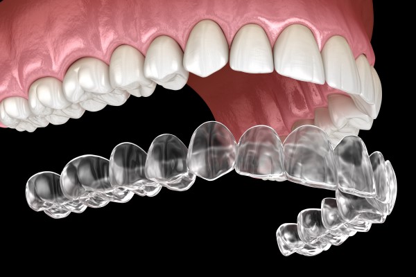 How Invisalign Retainers Prevent Tooth Relapse After Your Aligner Treatment Ends